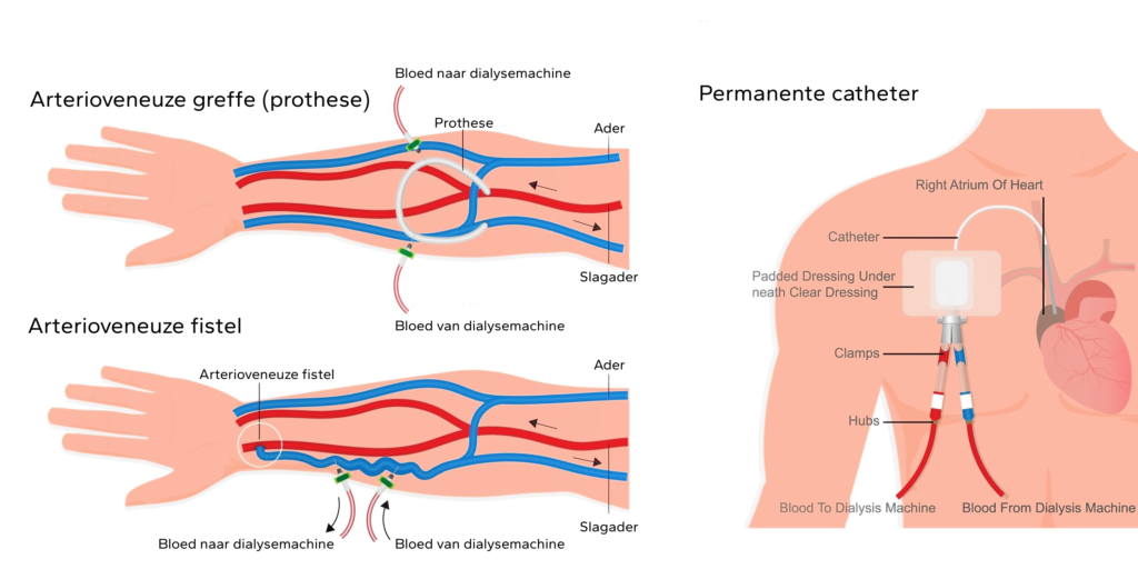 Arterioveneuze fistel