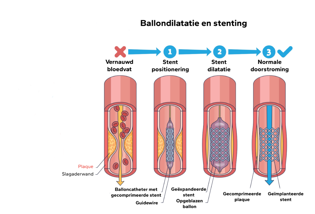 Ballondilatatie en stenting