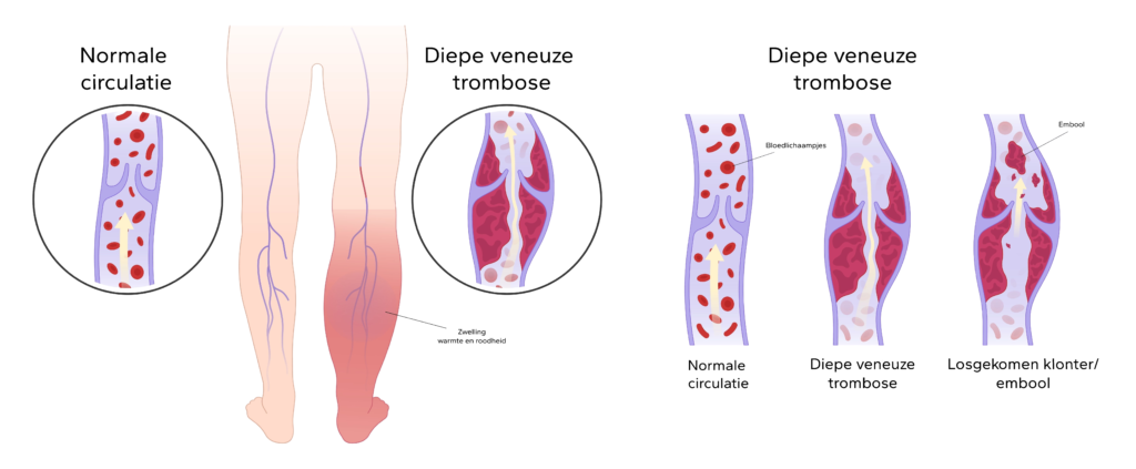 Diepe veneuze trombose