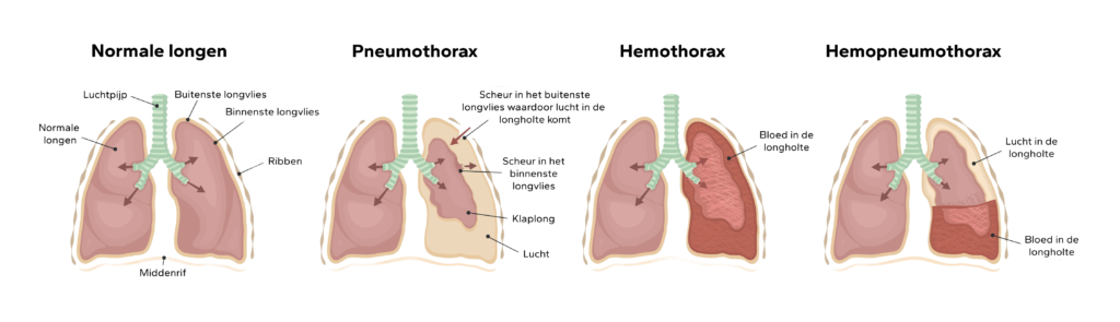 Pneumothorax