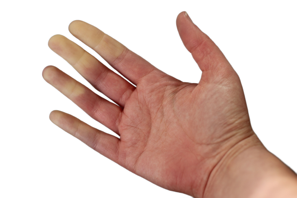 Raynaud fenomeen