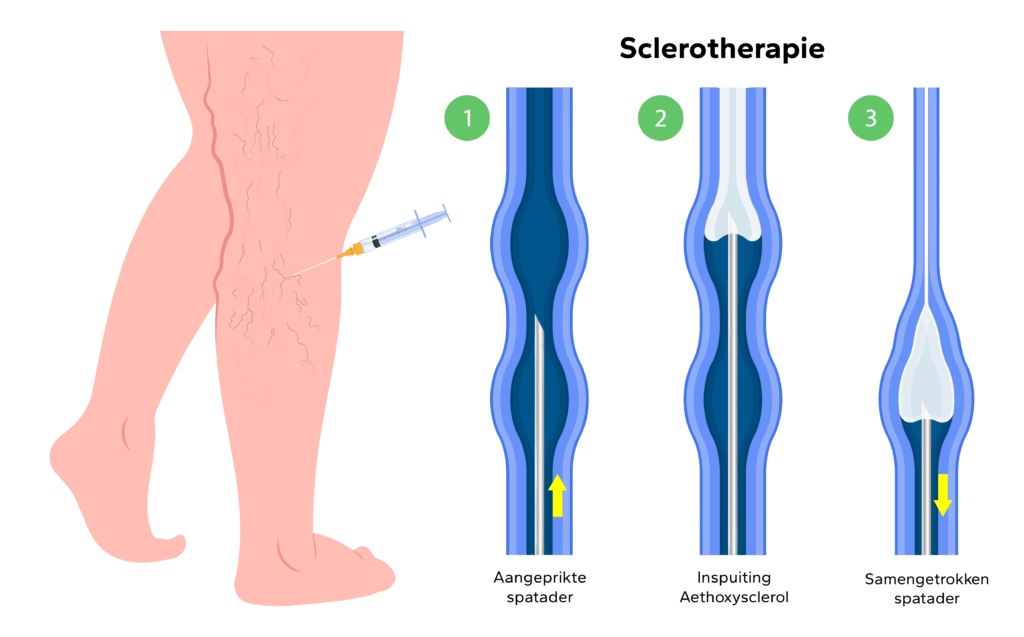 Sclerotherapie