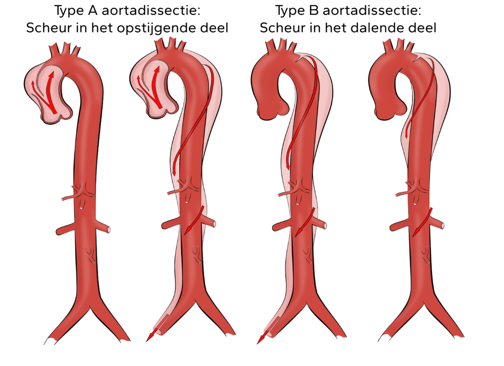 Aortadissectie