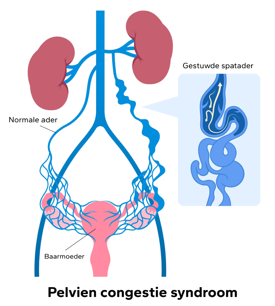 Pelvic congestion syndrome