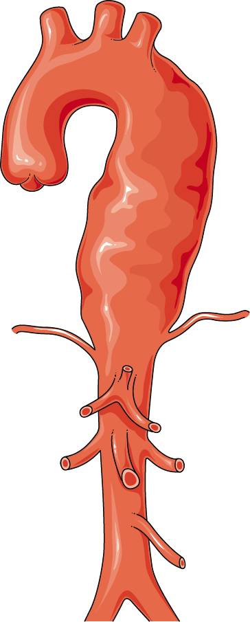 thoracaal aorta aneurysma